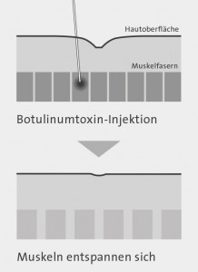 falten_botulinumtoxin