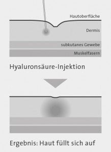 falten_dermafiller